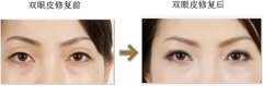 双眼皮修复手术的适应症有哪些