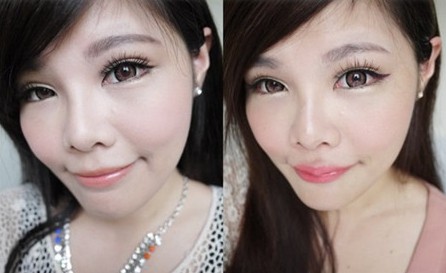 玻尿酸注射丰唇珠有哪些优势 玻尿酸注射丰唇珠有哪些适应症