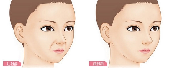 鼻唇沟填充术有哪些禁忌症 鼻唇沟填充术有哪些方法