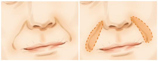 鼻唇沟填充术有哪些禁忌症 鼻唇沟填充术有哪些方法