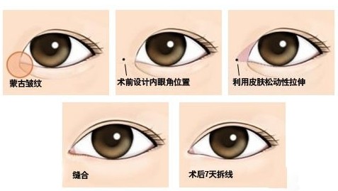 开眼角有后遗症吗 开眼角手术有什么后遗症