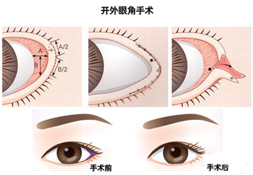 开眼角术后应该如何护理？怎么护理恢复快？