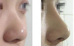 注射隆鼻恢复时间 注射隆鼻后注意事项