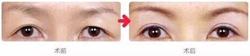 切眉术有哪些注意事项 切眉术前后对比图