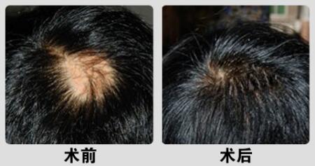 毛发种植多少钱 毛发种植前后对比图