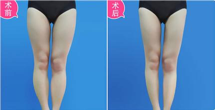 注射注射瘦腿有风险吗 注射注射瘦腿有什么优势