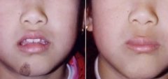 激光去胎记怎么样 激光去胎记有什么优势 激光去胎记怎么样 激光去胎记有什么优势