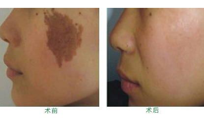 激光去胎记怎么样 激光去胎记有什么优势