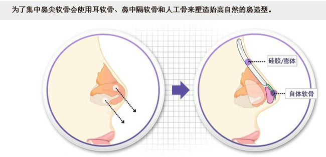 自体软骨隆鼻尖成好吗 自体软骨隆鼻尖有后遗症吗