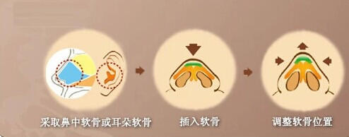 自体软骨隆鼻尖成好吗 自体软骨隆鼻尖有后遗症吗