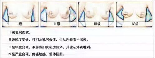 隆胸假体变硬了怎么办 假体隆胸躺着好假好硬