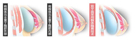 隆胸假体变硬了怎么办 假体隆胸躺着好假好硬