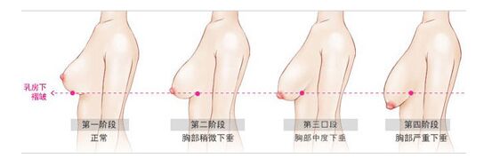 【隆胸方法】隆胸的方法有哪些适合你这个年龄?