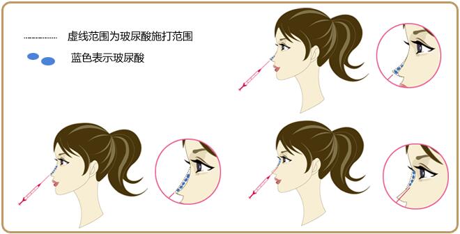 注射式隆鼻注意事项 注射式隆鼻如何护理