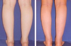 注射注射瘦脸注射瘦腿价格多少钱 注射注射瘦脸注射瘦腿前后对比图