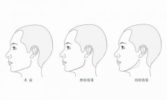 下颌角修复手术有哪些方式 下颌角修复手术前后对比图
