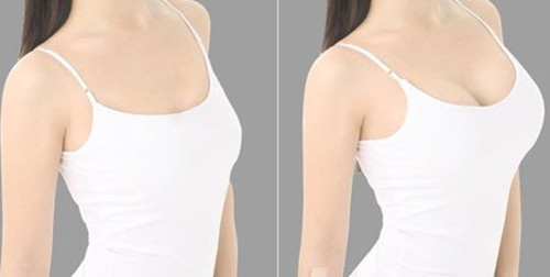 假体隆胸手术后需要注意什么 假体隆胸手术好不好影响哺乳