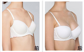 假体隆胸手术后需要注意什么 假体隆胸手术会不会影响哺乳