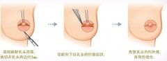 乳头内陷矫正术好吗 乳头内陷矫正术后应该如何护理 乳头内陷矫正术好吗 乳头内陷矫正术后应该如何护理
