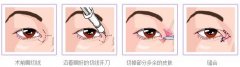 开眼角手术有后遗症吗 开眼角手术后怎么护理 开眼角手术有后遗症吗 开眼角手术后怎么护理