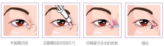 开眼角手术有后遗症吗 开眼角手术后怎么护理