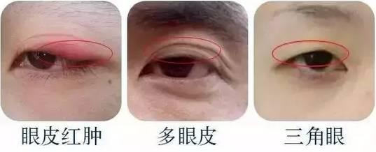 内双适合做哪种双眼皮手术果好