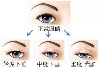 内双适合做哪种双眼皮手术果好