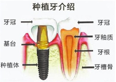 种植牙与烤瓷牙区别?哪个好?