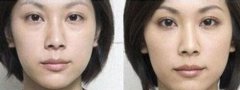去眼袋有的方法 去眼袋的小窍门 去眼袋有的方法 去眼袋的小窍门