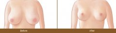 巨大乳房缩小术的步骤是什么 巨大乳房缩小术前后对比图