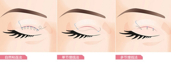 埋线定位双眼皮做的不理想可以修复吗