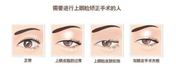 上睑下垂手术危险吗 上睑下垂矫正后遗症