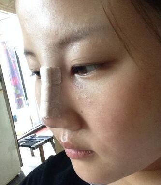 【假体隆鼻】假体隆鼻手术后多久可以化妆 假体隆鼻手术后要注意什么