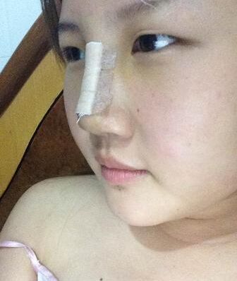 【假体隆鼻】假体隆鼻手术后多久可以化妆 假体隆鼻手术后要注意什么