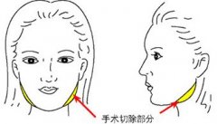 v-line和下颌角整形手术有什么区别