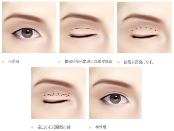 【双眼皮手术】双眼皮手术原理 双眼皮手术后要拆线吗