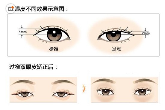 双眼皮拆线好还是不用拆线好