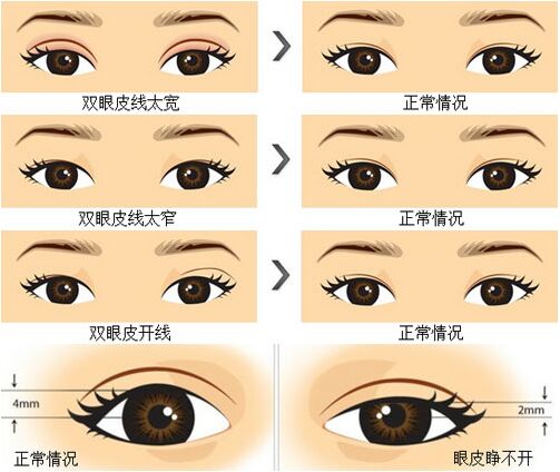 双眼皮失败怎么能修复成单眼皮 修复失败双眼皮的新方法