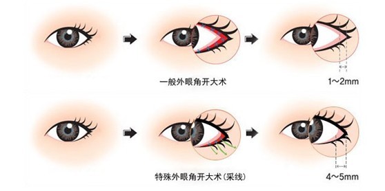 开内眼角和开外眼角的区别 开内眼角好还是开外眼角好