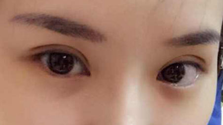 割双眼皮平行和扇形哪个好 双眼皮平行和扇形的区别