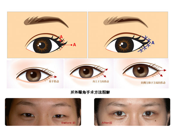 【开外眼角】开外眼角后眼睛会容易回缩么