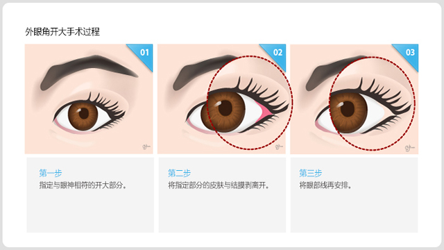 【开外眼角】开外眼角后眼睛会容易回缩么