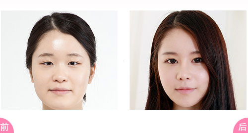 【开外眼角】开外眼角后眼睛会容易回缩么