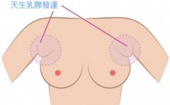 副乳手术多少钱 副乳手术前后对比图