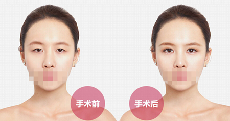 韩式切开双眼皮多久可以消肿