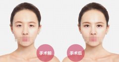 内眼角开太大该怎么修复 内眼角开太大该怎么修复