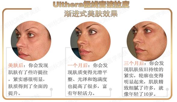 Ulthera极限音波拉皮和电波l皮区别有哪些