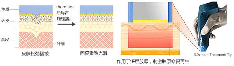 Ulthera极限音波拉皮和电波l皮区别有哪些