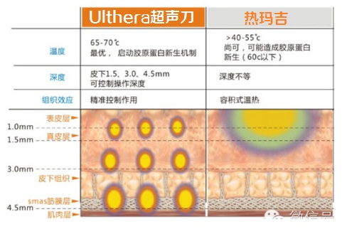 Ulthera极限音波拉皮和电波l皮区别有哪些