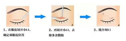 广州曙光割双眼皮手术要花多少钱?哪里好?
